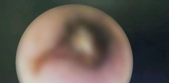 广州一男子半夜被蟑螂钻进耳朵医生：它以为有好吃的