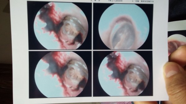 浙江大学研究：如何知道自己以后得帕金森？很简单掏出耳垢看一看