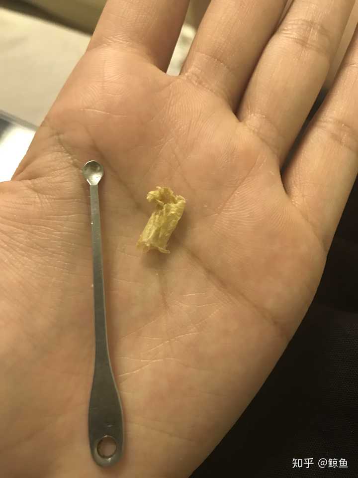 为什么耳屎是黑色的